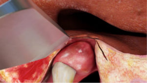 2C-3D Unilateral only 3D - Video HD complete