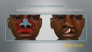 2C-3D Unilateral cleft lip - Video HD complete