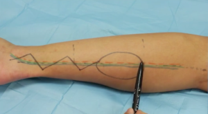 Distally based Sural artery neurocutaneous flap