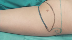 inf_gluteal_perfo