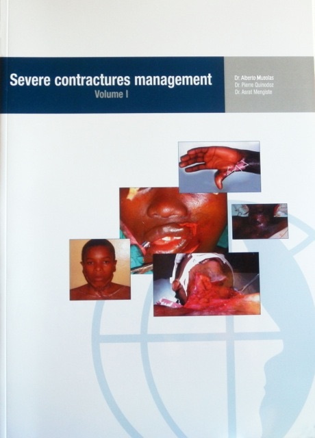 severe_contractures_management1