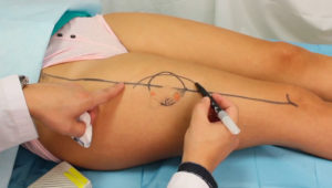 anterolateral_thigh_flap
