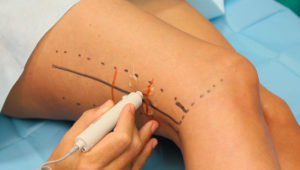 biceps_femoris_perforator_flap