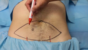 diep_flap_epigastric