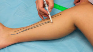 distal_soleus_muscle_flap