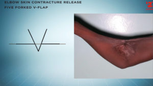 Elbow Skin Contracture - 5 Forked V Flap
