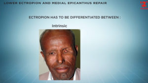 electropion