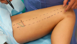 gracilis_myocutaneous_flap