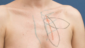 internal_mammary_artery_perfo