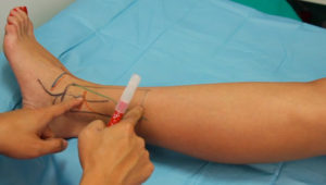 lateral_supramalleolar_skin_flap