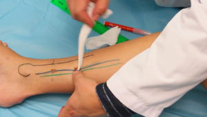 lower-posterior_tibial_perforator