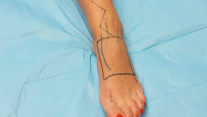 lower_dorsalis_pedis