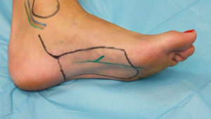 lower_medial_plantar-artery