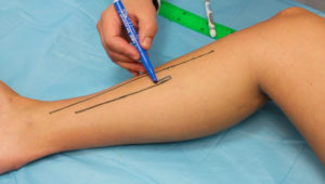 medial_gastronemious_flap