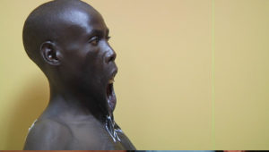 neck_contracture_release