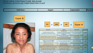 neck_contracture_supraclavicular_perforator