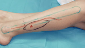 peroneal_artery_perforator_flap