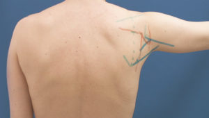 scapular_and_parascapular_flap.jpg