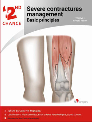 severe_contracture_management