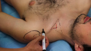 superclavicular_perfo
