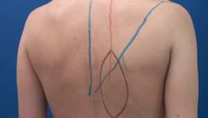 trapezius_flap