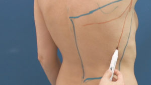 trunk_latissimus_dorsi_flap