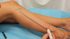 vascularized-osteocutaneous-fibula-flap