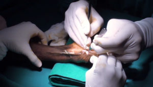 wrist_thumb_and_finger_skin_contracture