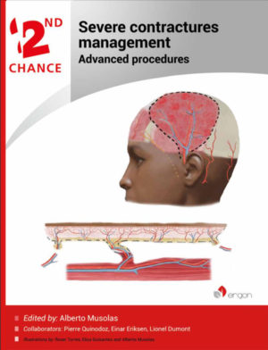 Severe Contractures Management | Advanced procedures