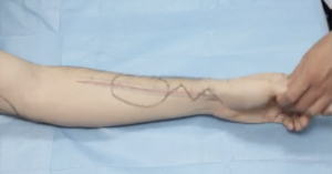 Forearm radial artery flap